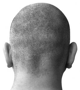 baldness