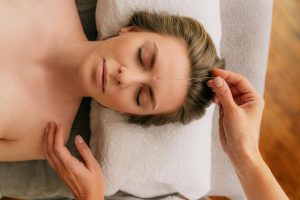 woman getting Acupuncture for Hair Loss